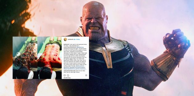 ‘Nampak Menyeksakan’- Pelakon Avengers ‘Thanos’ Buat Bekam, Ini Reaksi Pengikutnya Di Instagram