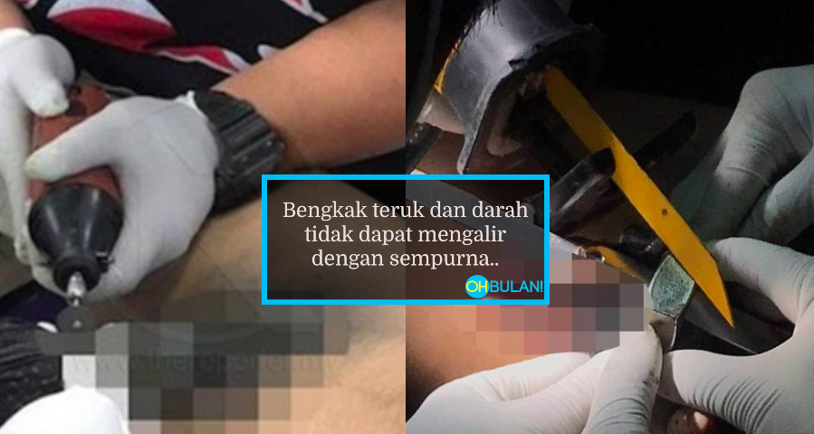 Malu Nak Pergi Hospital, Kemaluan Lelaki Tersangkut 5 Hari Dalam Batang Paip Kehitaman & Hampir Reput