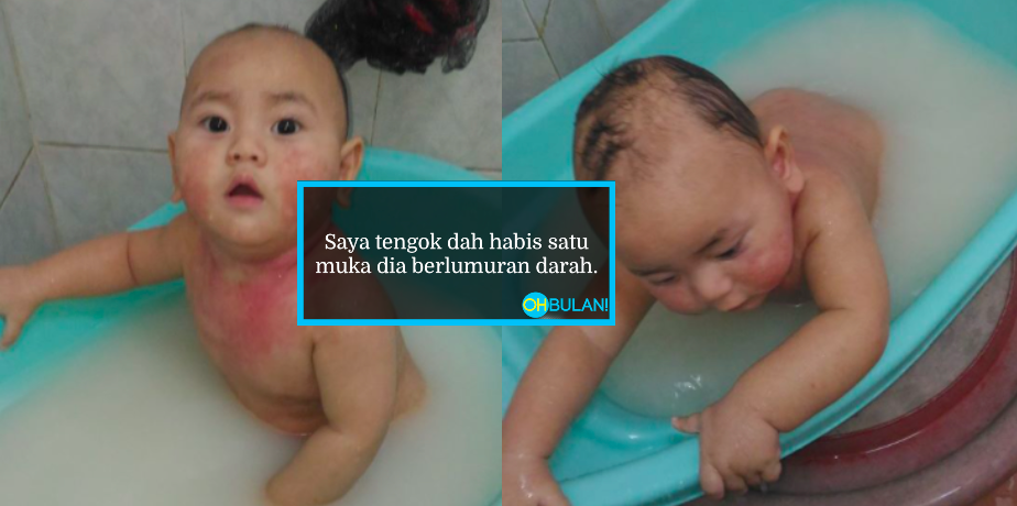 ‘Satu Muka Berlumuran Darah, Duit Habis Berbelas Ribu’ – Ibu Kongsi Penderitaan Anak Hidap Ekzema
