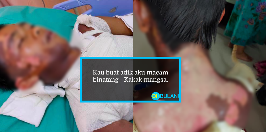 ‘Badan Melecur, Jari Telunjuk Patah & Diugut Bunuh’ – Kakak Berang Adik Diperlakukan Seperti Haiwan