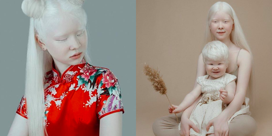 [FOTO] Miliki Kecantikan Luar Biasa, Dua Beradik Albino Ini Kini Jadi Model Rebutan