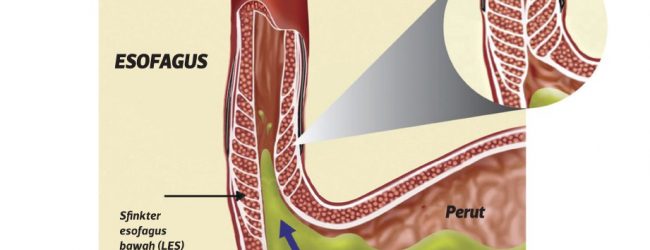 Dah Bertahun Menderita, Pesakit Ingatkan Hanya GERD Biasa 