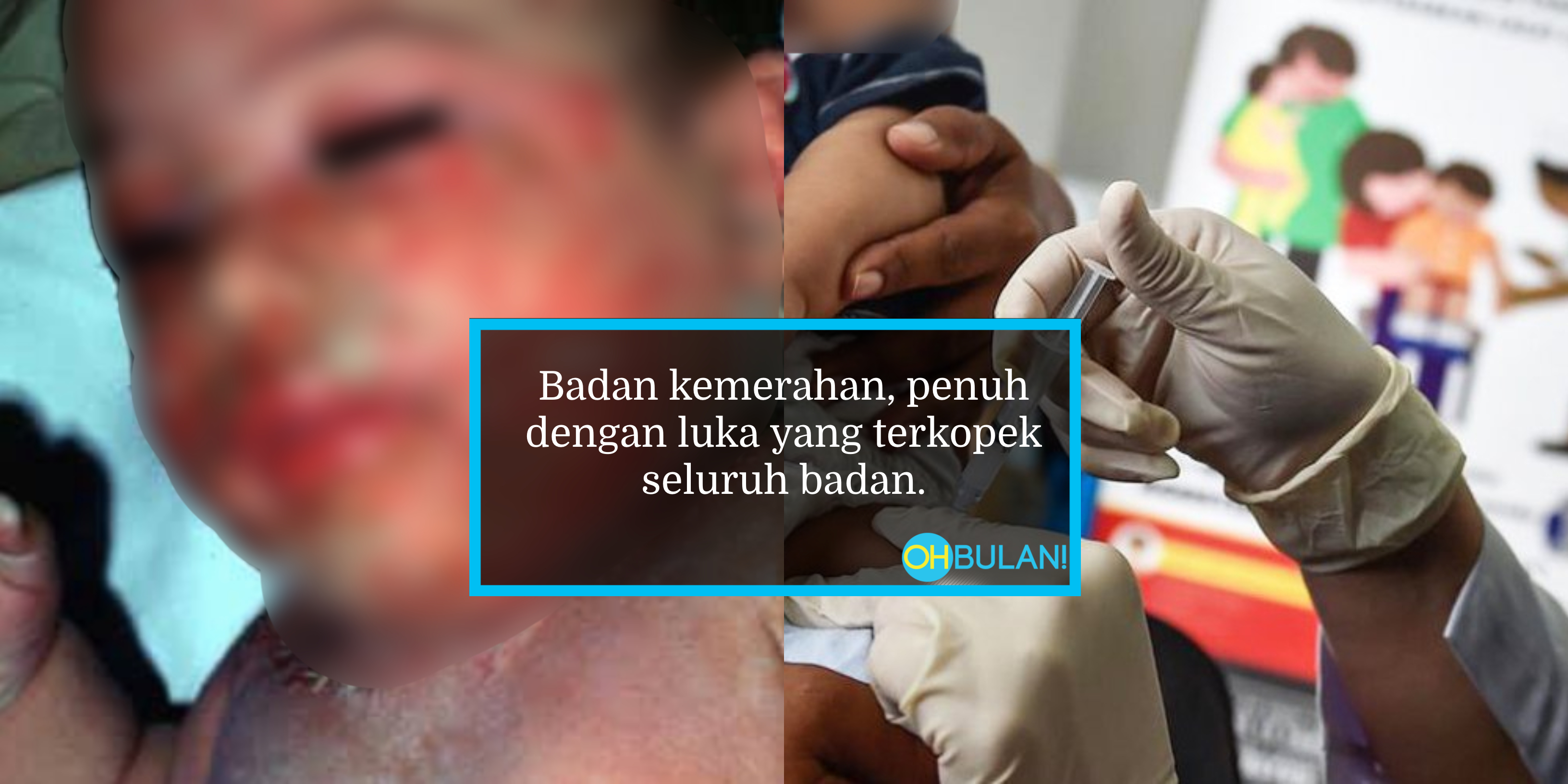 Anak 7 Bulan Macam Mayat Rentung Ibu Bapa Antivax Enggan Rawat Anak Walaupun