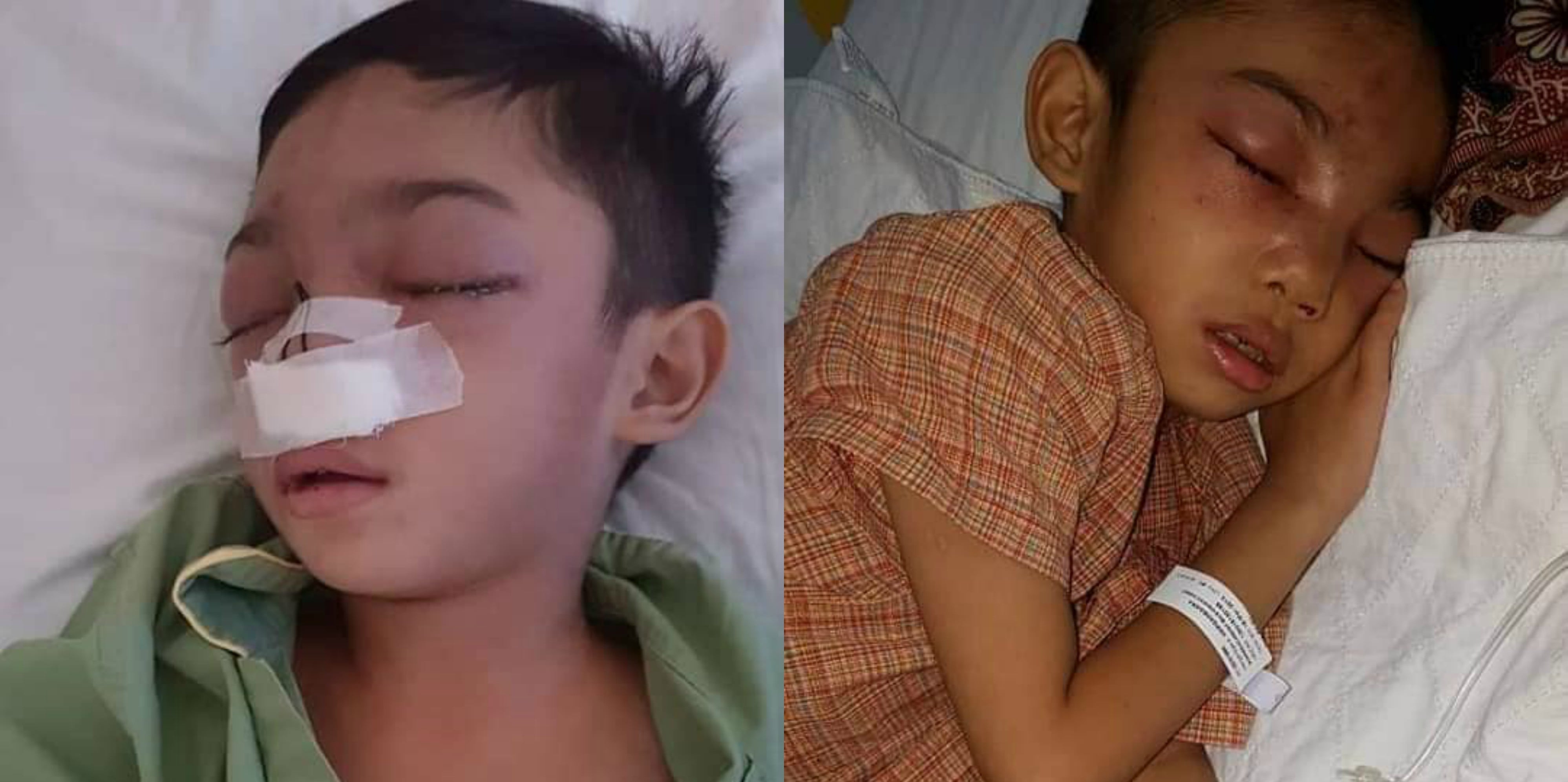 Budak Berusia 6 Tahun Dibuli ‘Senior’ Sehingga Retak Tulang Hidung, Keluarga Luah Rasa Terkilan