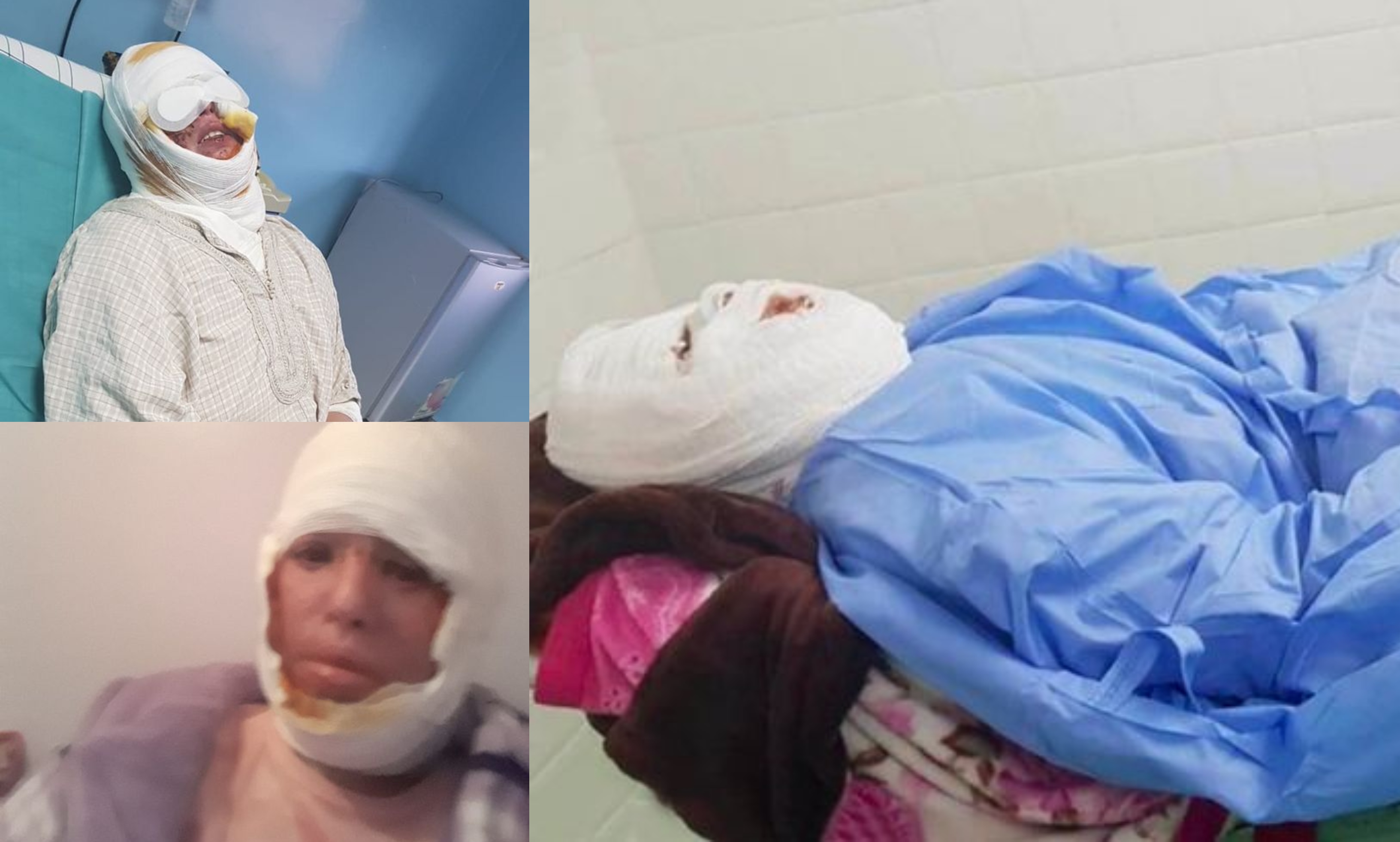 Isteri Derita Pekak & Bisu, Suami Durjana Simbah Minyak Panas Ketika Sedang Tidur