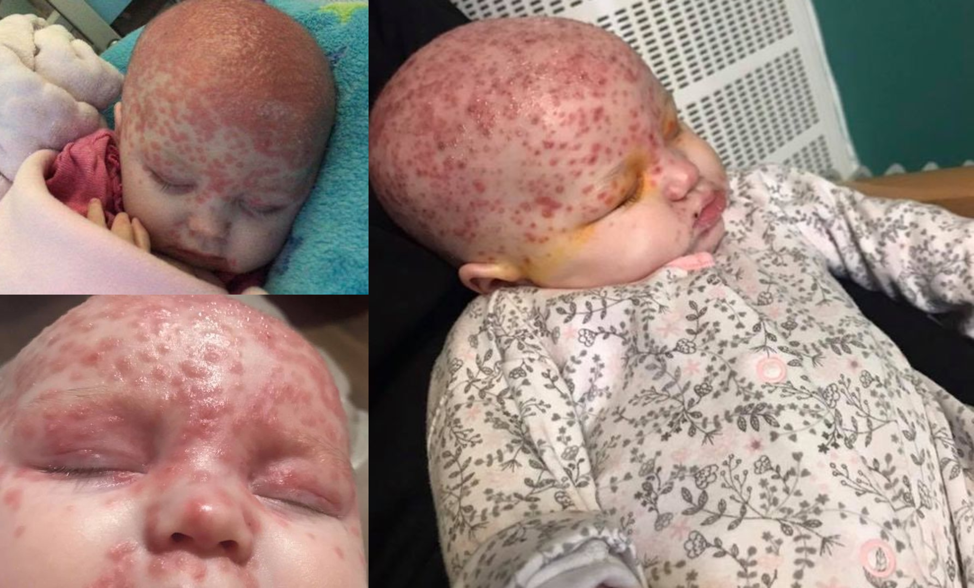 Hanya Dengan Satu Ciuman, Ibu Terkejut Bayi 6 Bulan Dijangkiti Virus Herpes