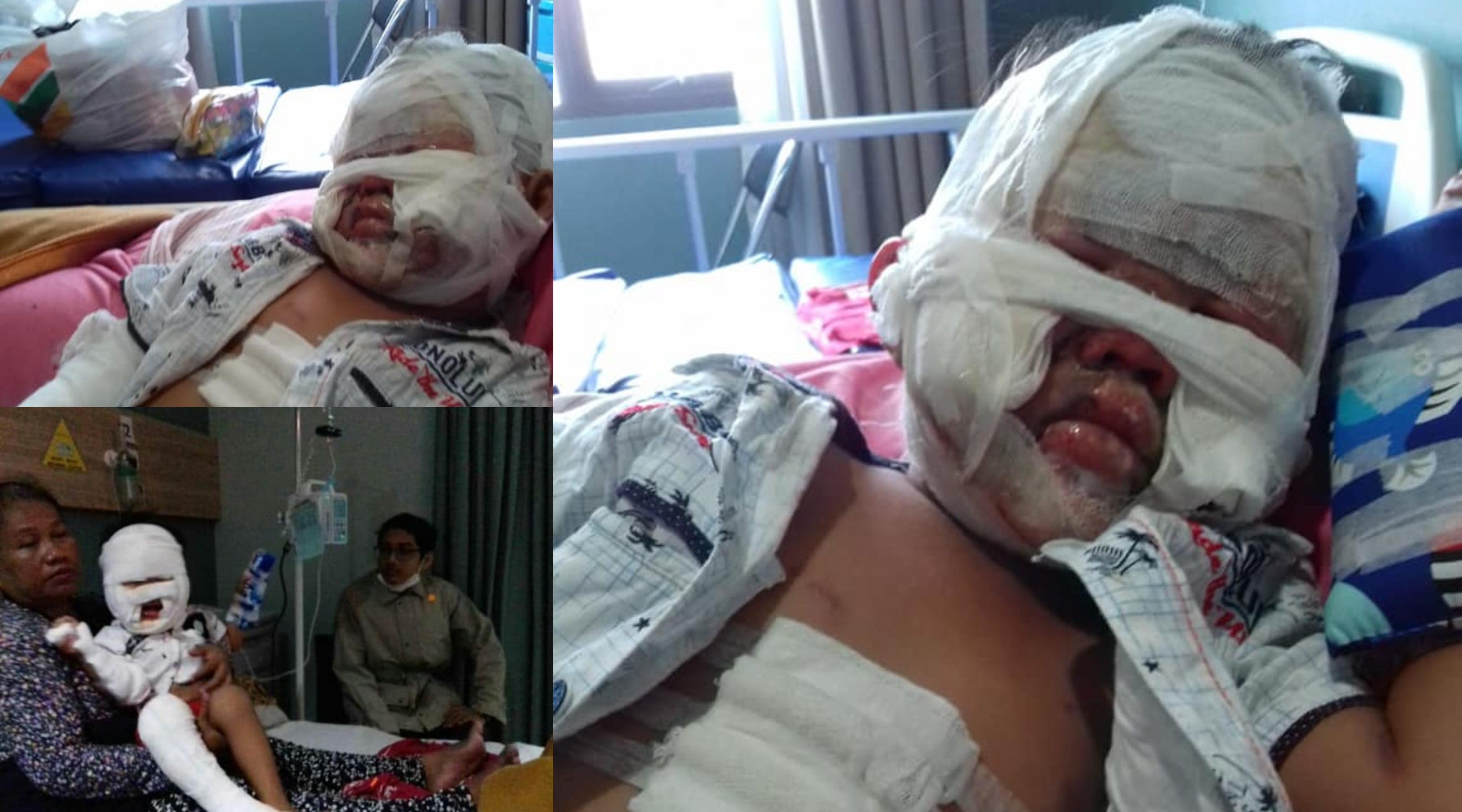 Budak 3 Tahun Pegang Botol Hand Sanitizer Melecur Teruk Disambar Api