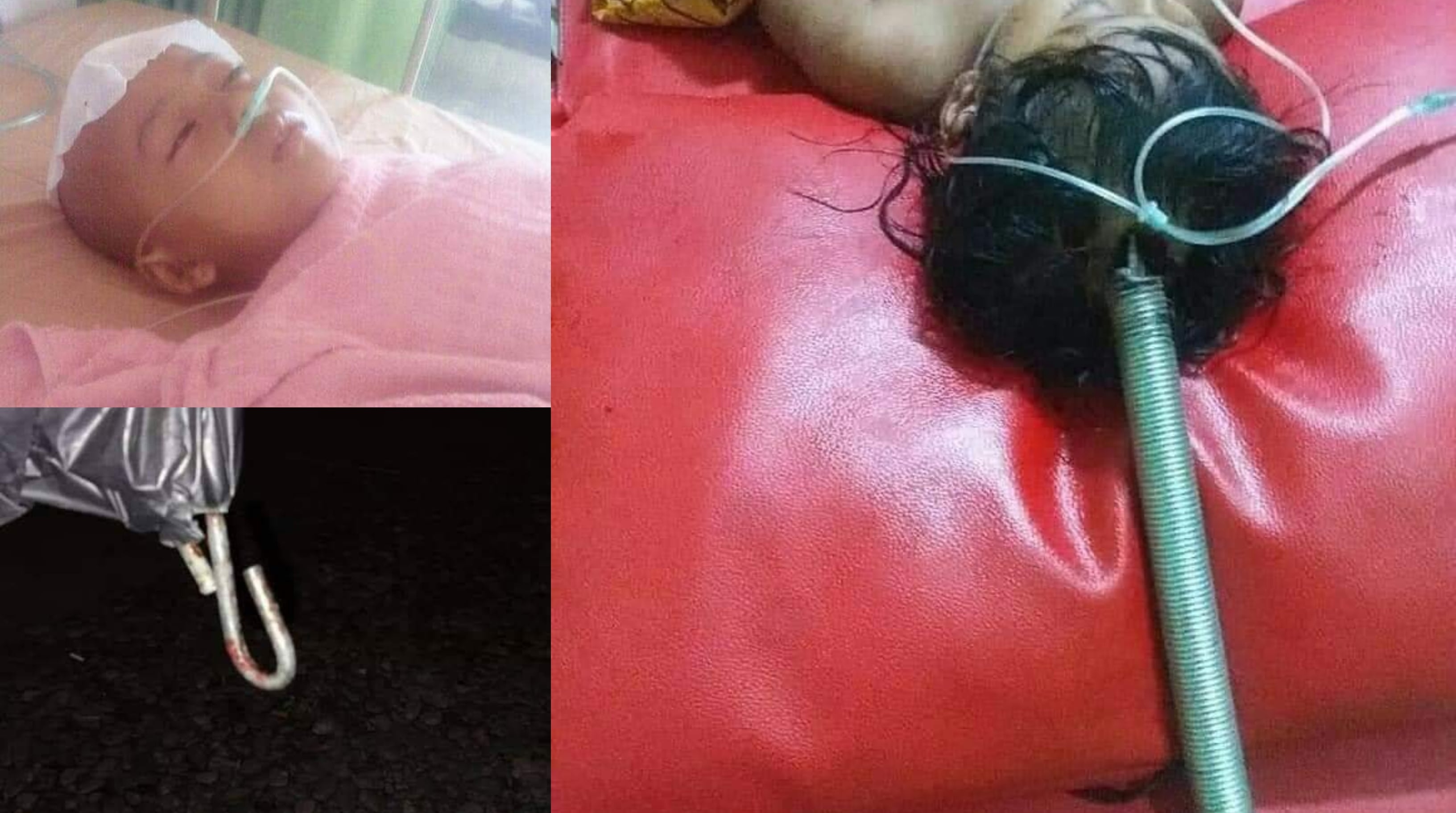 Tali Buaian Terputus, Tempurung Kepala Kanak-Kanak 6 Tahun Retak Tercucuk Besi