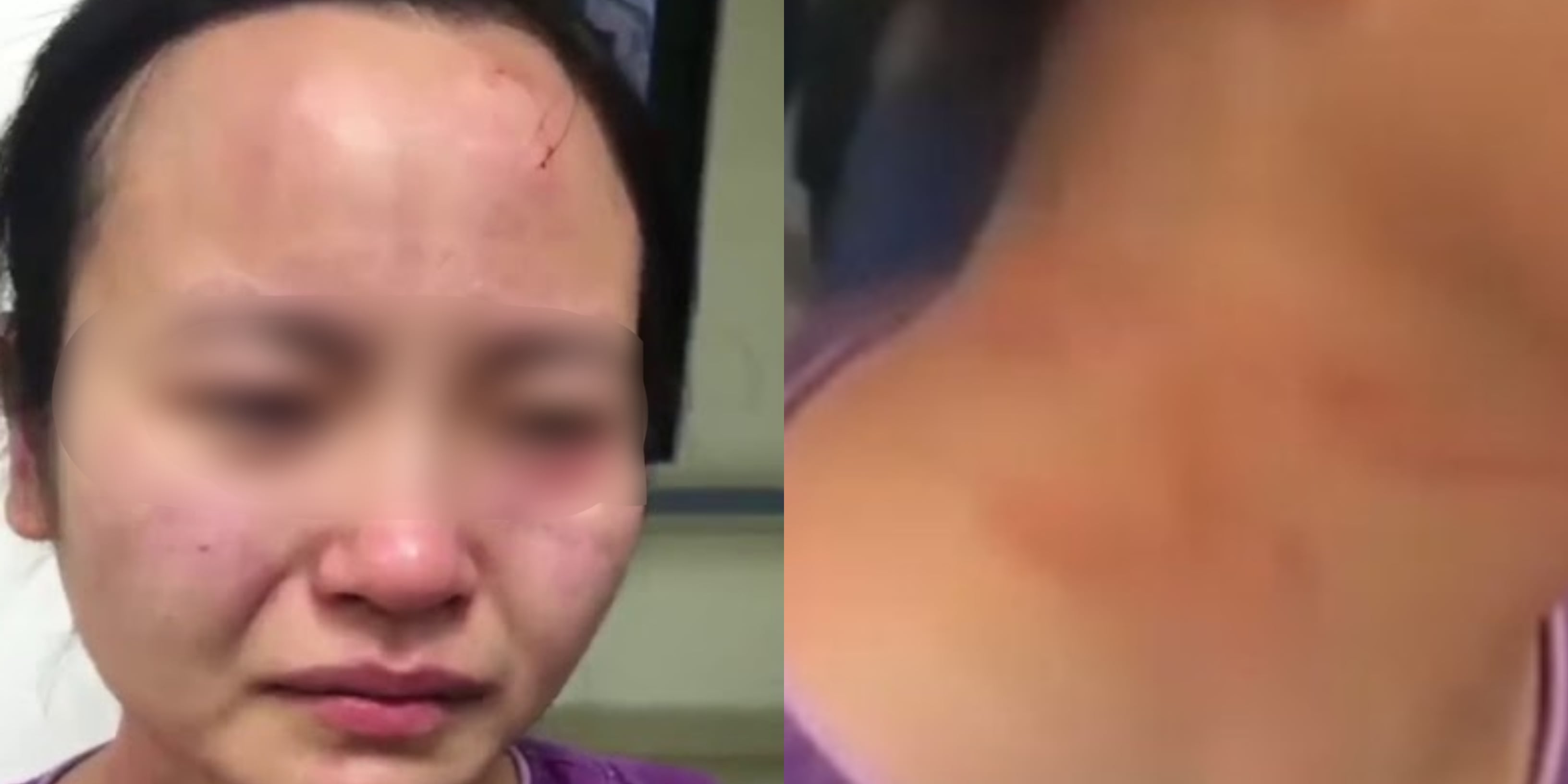 Jururawat Dipukul, Muka Digigit Pesakit COVID-19 Yang Enggan Dirawat