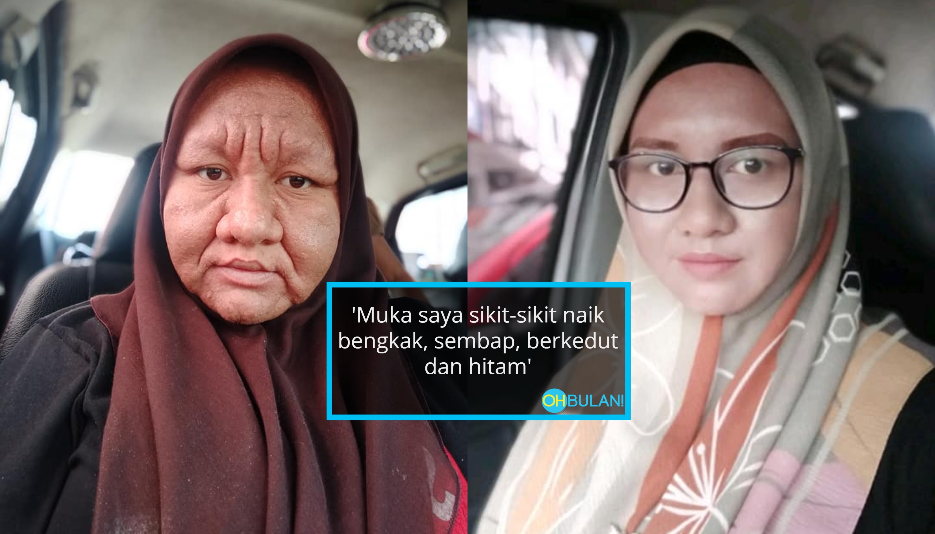 Wajah Bengkak, Berkedut Seperti Wanita Tua Ketika Hamil