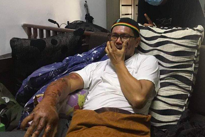 Badan Melecur Disambar Api Ketika Bakar Sampah, Berat Ali XPDC Susut 20kg