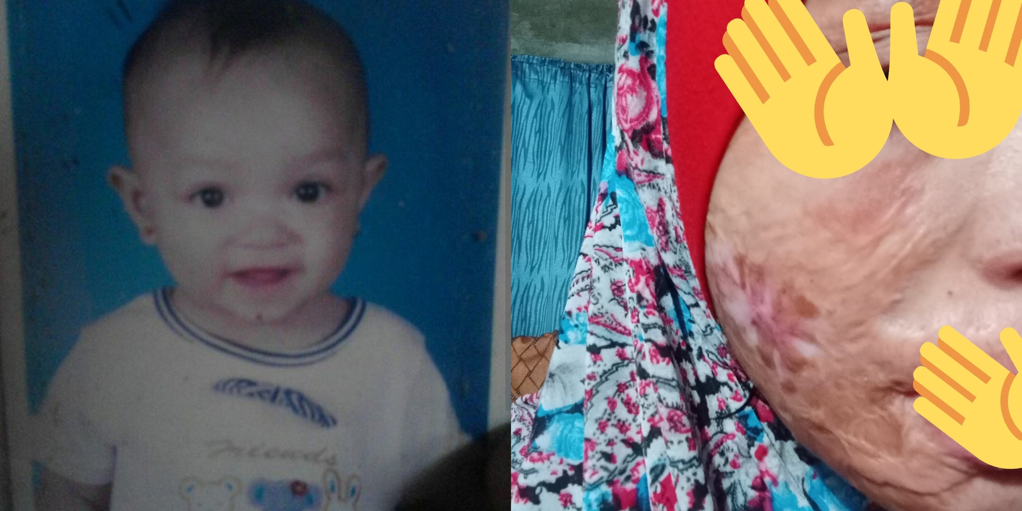 ‘Cacat, Terbakar, Muka Buruk’ – Gadis ‘Throwback’ Tragedi Hitam Jadi Mangsa Kebakaran Masa Umur 3 Tahun