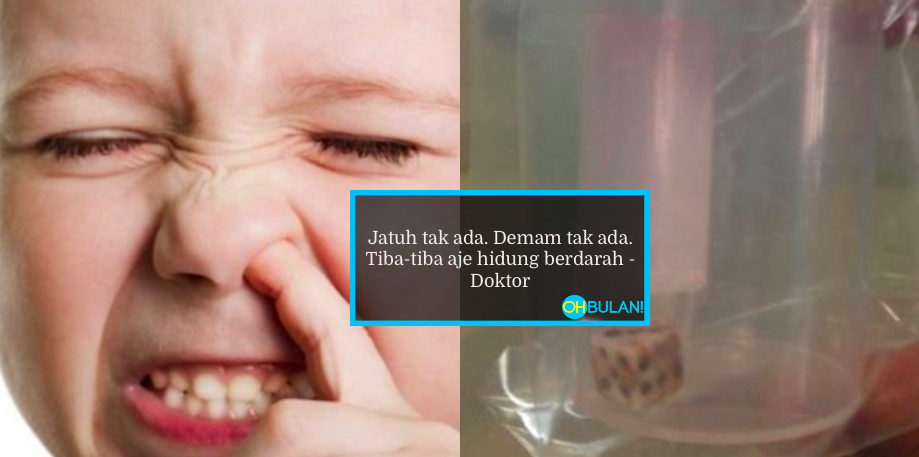 Hidung Tiba-Tiba Berdarah Tanpa Henti, Rupanya Dah 3 Tahun Dadu Tersumbat…