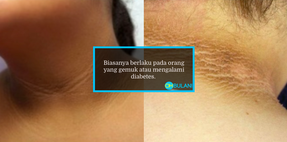 Gelap Di Ketiak, Pangkal Paha & Leher? Doktor Kongsi Punca Sebenar & Cara Atasi