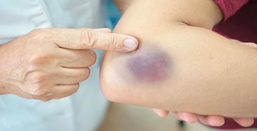 Lebam Di Badan Kerana Gangguan Mistik? Ini Fakta Sebenar Jawab Teori ‘Karut’