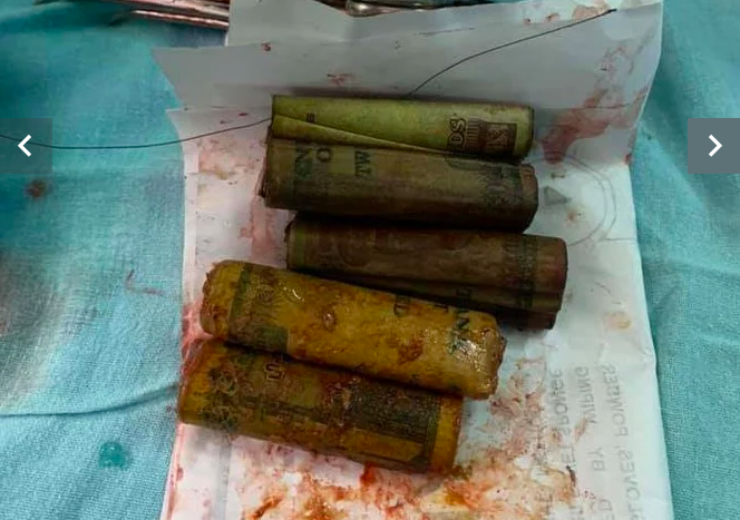 ‘Menabung’ Dalam Perut, Doktor Temui Duit Bernilai RM 1,580 Selepas Lakukan Pembedahan