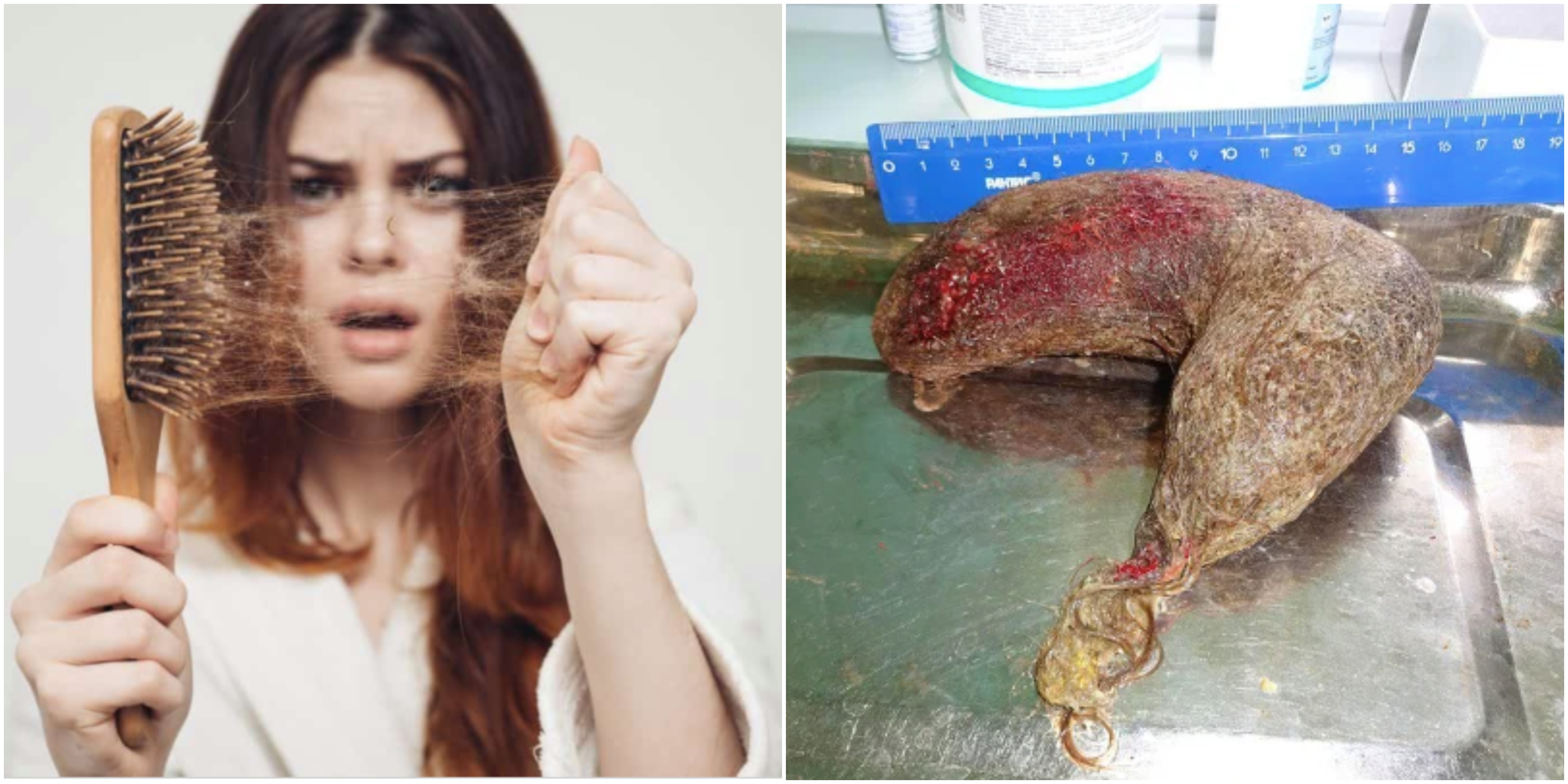 Jumpa 7kg Gumpalan Rambut Dalam Perut, Ini Perkara Yang Anda Perlu Tahu Mengenai ‘Trichophagia’