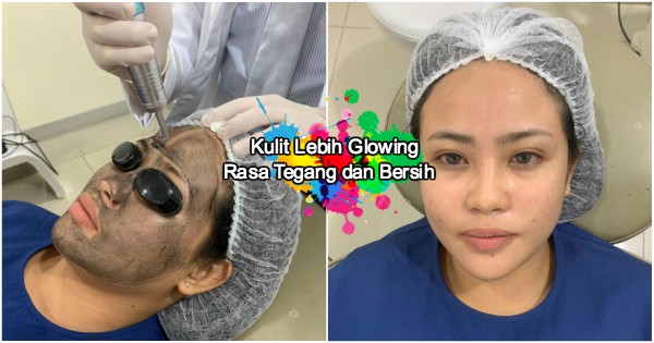 Kulit Kian Mulus! – Tampil Lebih Yakin Dengan Rawatan Carbon Laser Pada Harga Mampu Milik