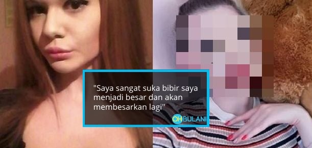 Tidak Peduli Nasihat Doktor, Gadis Ini Tekad Lakukan Suntikan Bibir Ke-21