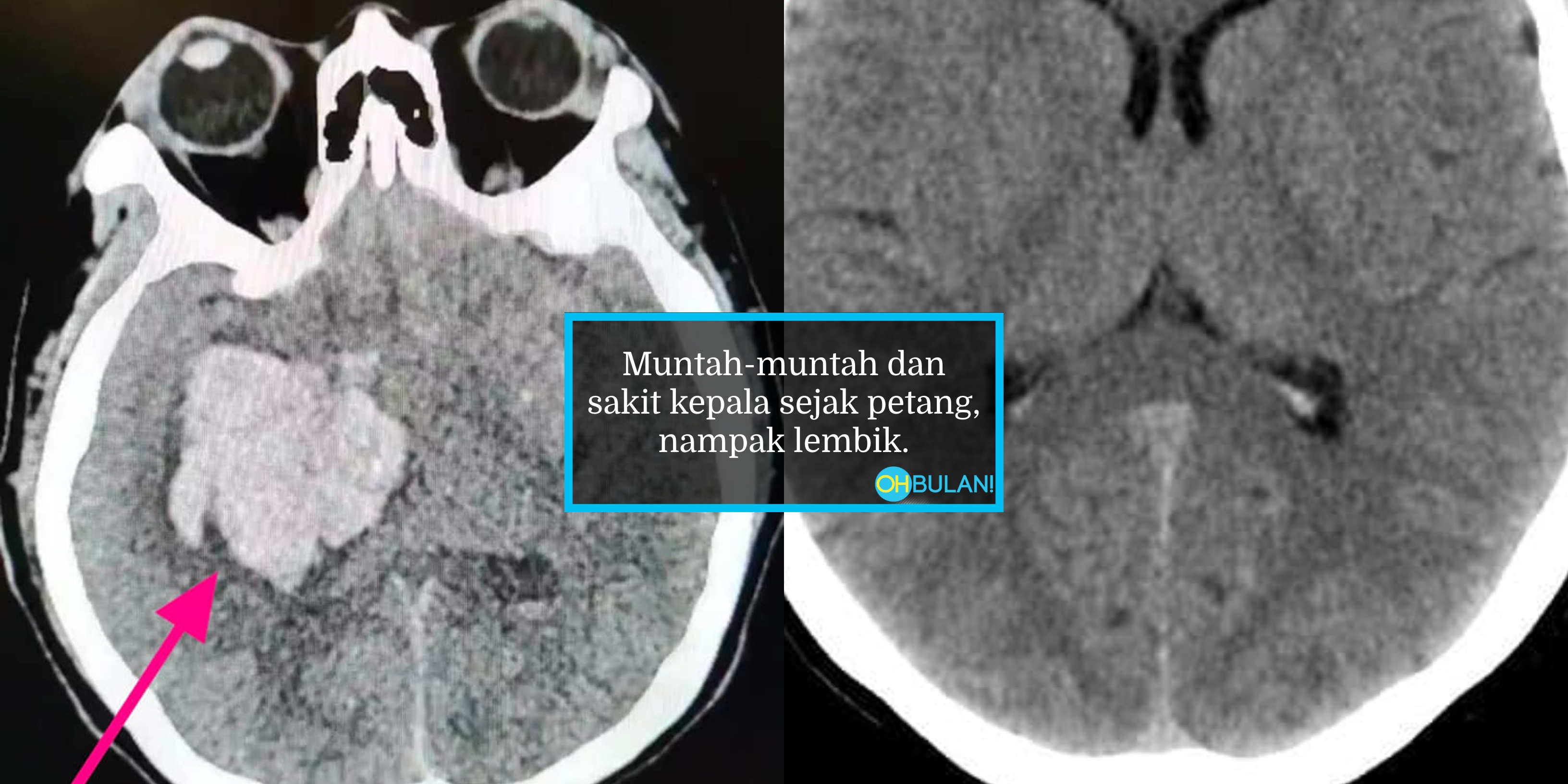 Enggan Makan Ubat Hospital, Pesakit Ditolak Ke Zon Merah, Berlaku Pendarahan Dalam Otak