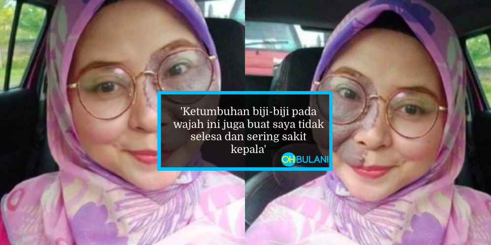 ‘Muka Tu Kena Sumpah Ke?’ – Sering Diejek Sejak Kecil, Wanita Akui Pernah Ada Niat Bunuh Diri
