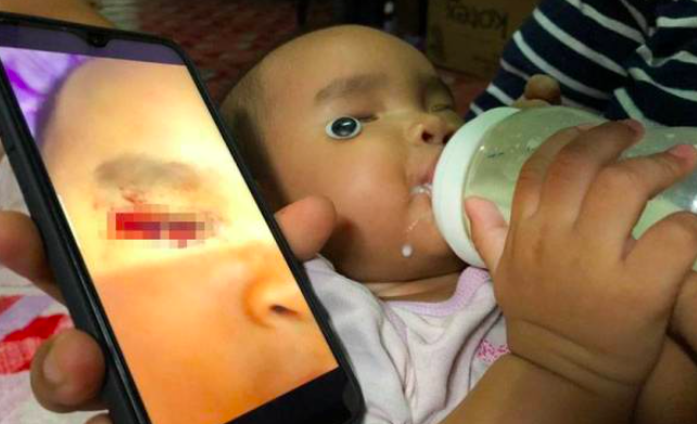 ‘Bila Buka Lampu Rupa-Rupanya Darah..’ – Ibu Terkejut Tengok Bebola ‘Mata’ Anak Terkeluar