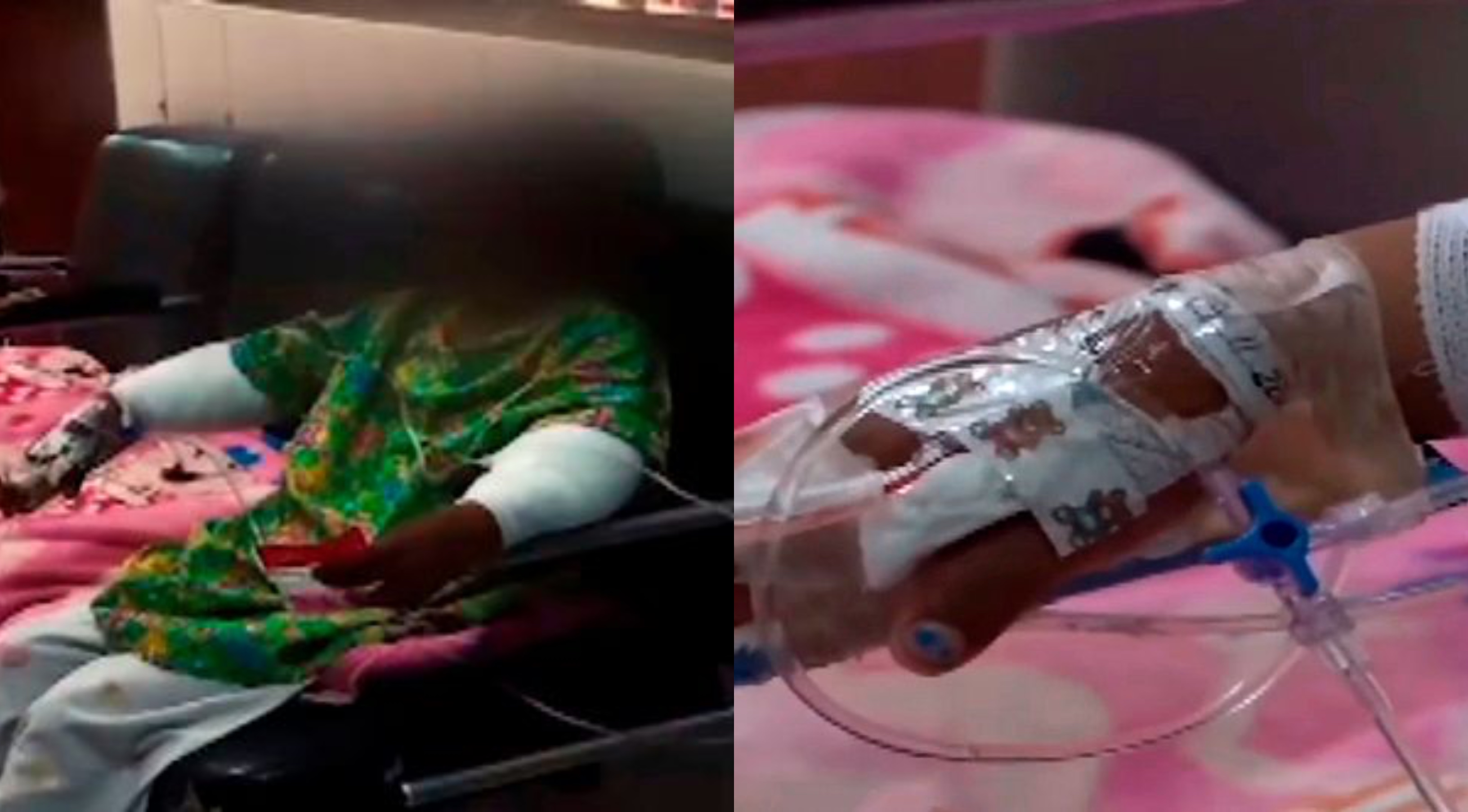 Adik Sempat Lari Lepas Tengok Ibu Bakar Tangan Kakak, Hanya Kerana ‘Curi’ Gula-Gula