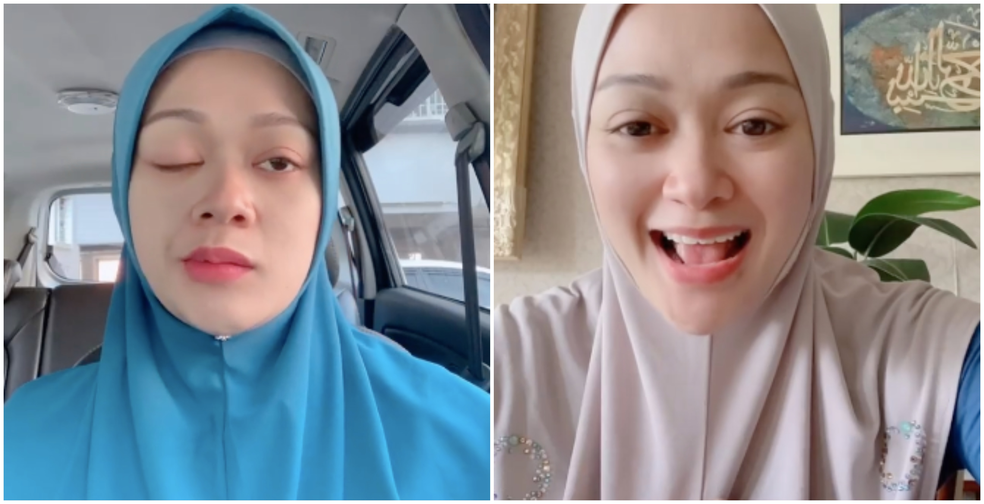 Selepas 4 Minggu, Akhirnya Faye Kusairi Sembuh Dari Bell’s Palsy