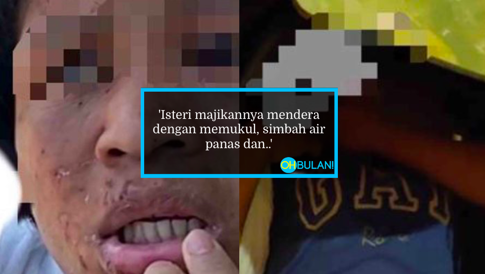 Ditekap Dengan Seterika, Ada Kesan Jahitan Luka, Pembantu Rumah ‘Lunyai’ Kena Dera
