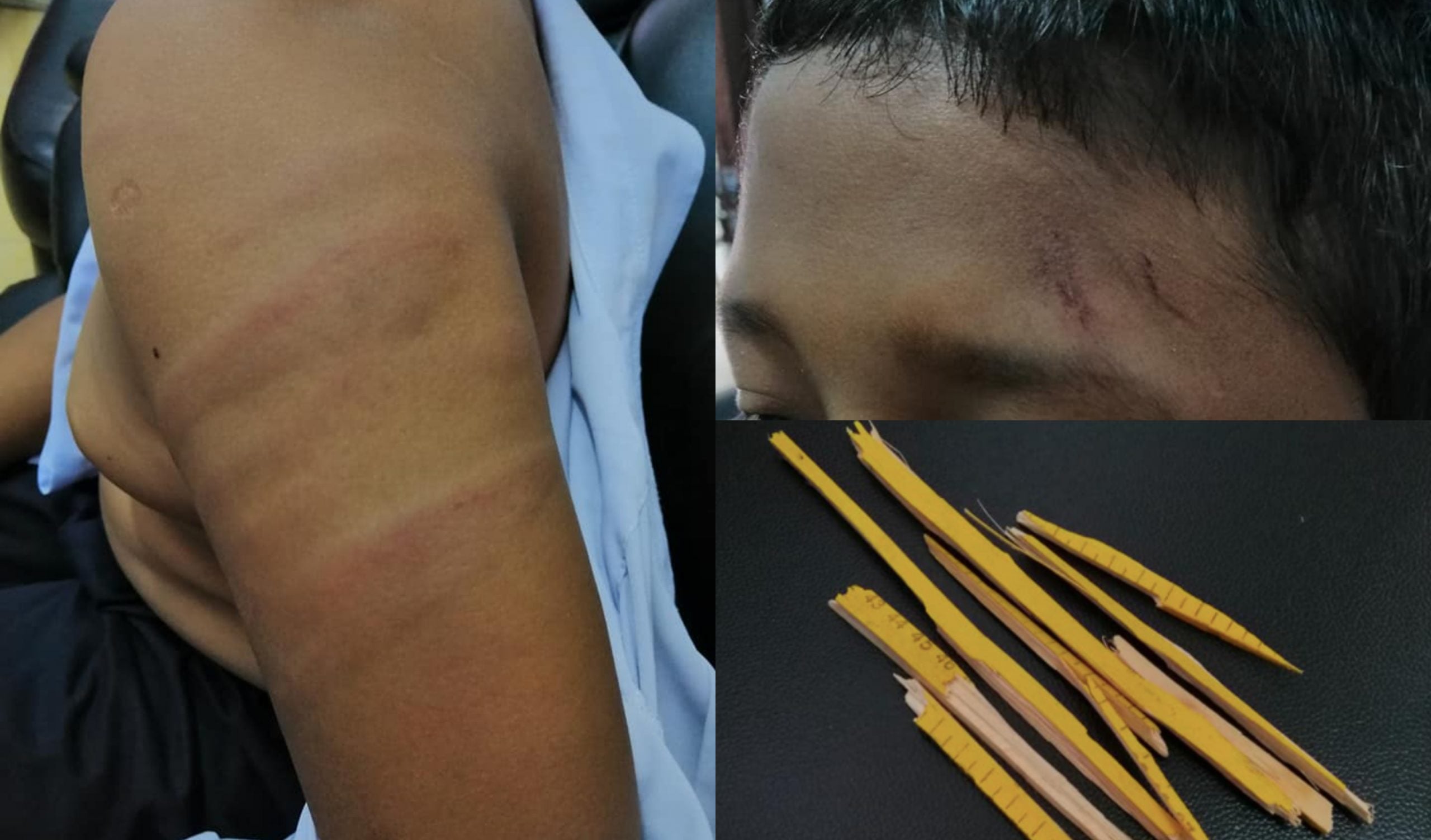 Ibu Lapor Polis, Dakwa Anak Teruk Kena ‘Tibai’ Dengan Cikgu Sebab Tak Siap Kerja Sekolah