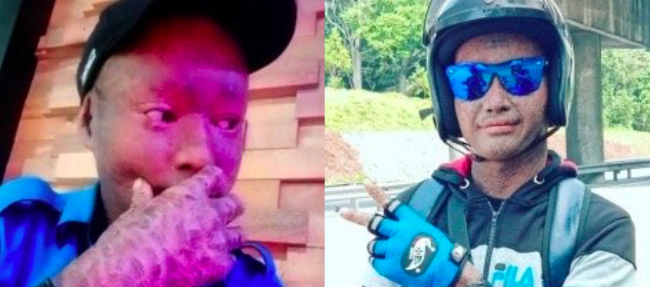 ‘Saya Tak Minta Lahir Begini’ – Diperli Terkena ‘Sumpahan’ Sebab Kulit ‘Bersisik’, Pemuda Sedih Dicemuh Netizen
