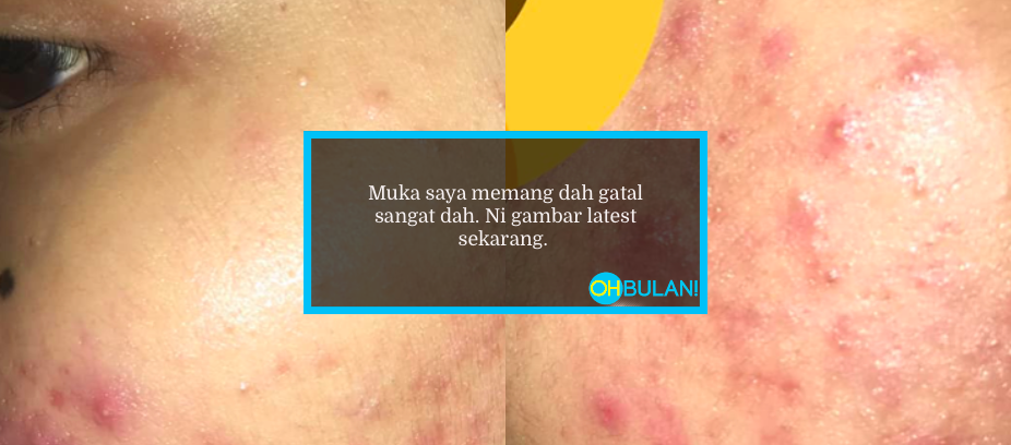 ‘Bukan Saja-Saja Buka’ – Gadis Hidap Masalah Kulit Muka Sensitif Dikompaun RM1.5k