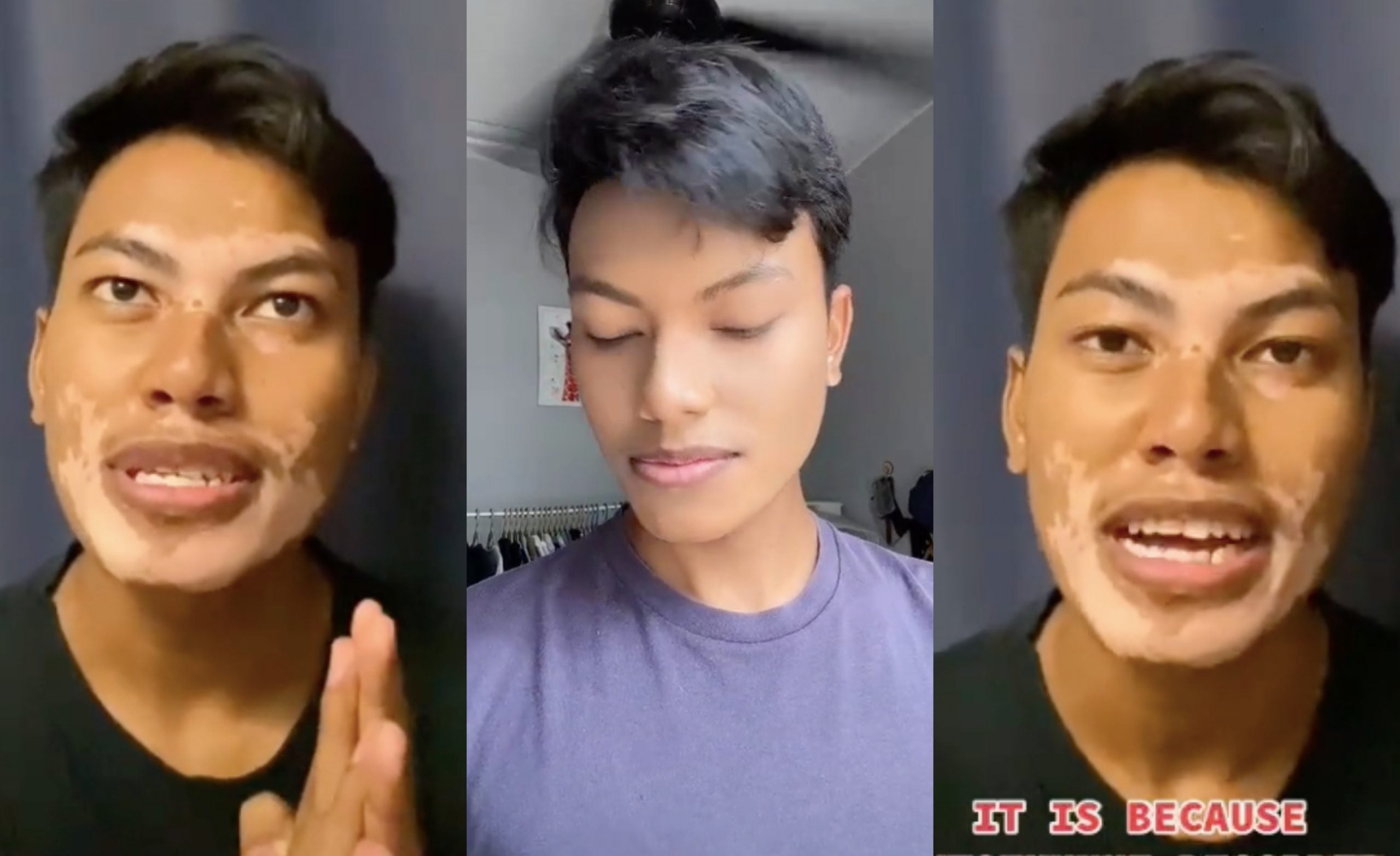 [VIDEO] Bermula Dengan Tompok Kecil Di Muka, Lelaki Hidap Penyakit Kulit Vitiligo Kongsi Cerita
