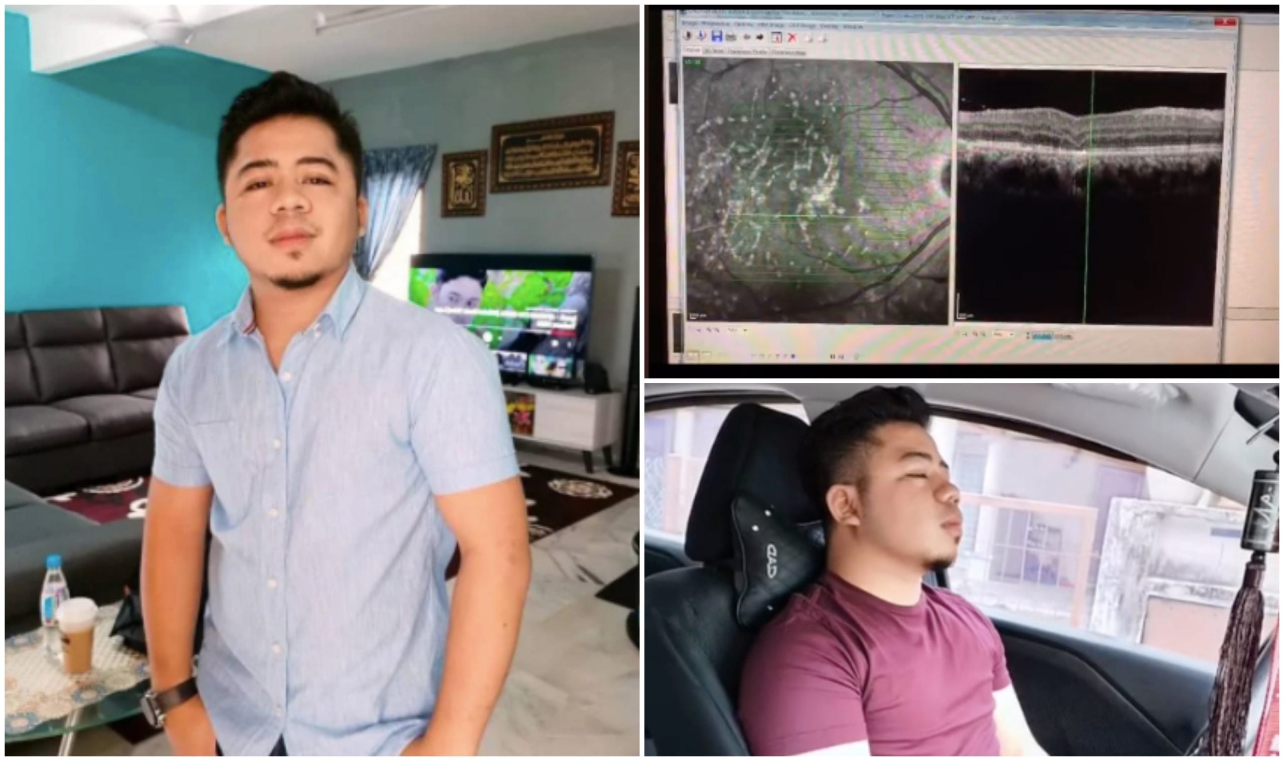 Akibat Tersalah Laser Di Saraf Optik, Pemuda ‘Down’ & Reda Mata Kanan Jadi Buta Selamanya