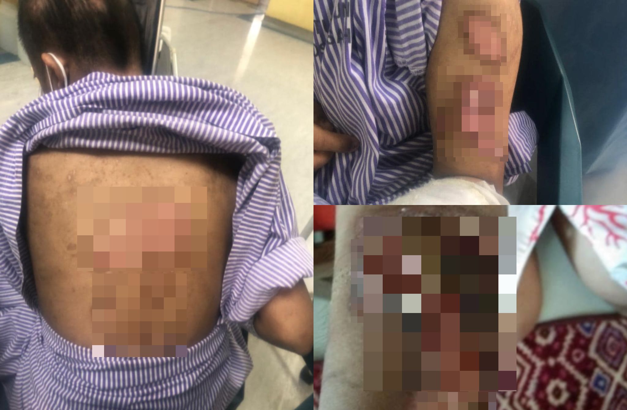Remaja Sindrom Down Disyaki Didera Di Rumah Kebajikan, Satu Badan Penuh Luka & Parut Ketika Diselamatkan