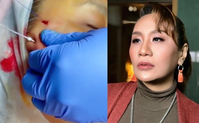 Netizen Ragu Dengan Rawatan ‘Tanam Benang’, Amelina Nafi Ubah Rupa Bentuk – ‘Kak Long Cuma Tarik Kulit Bukan Potong’