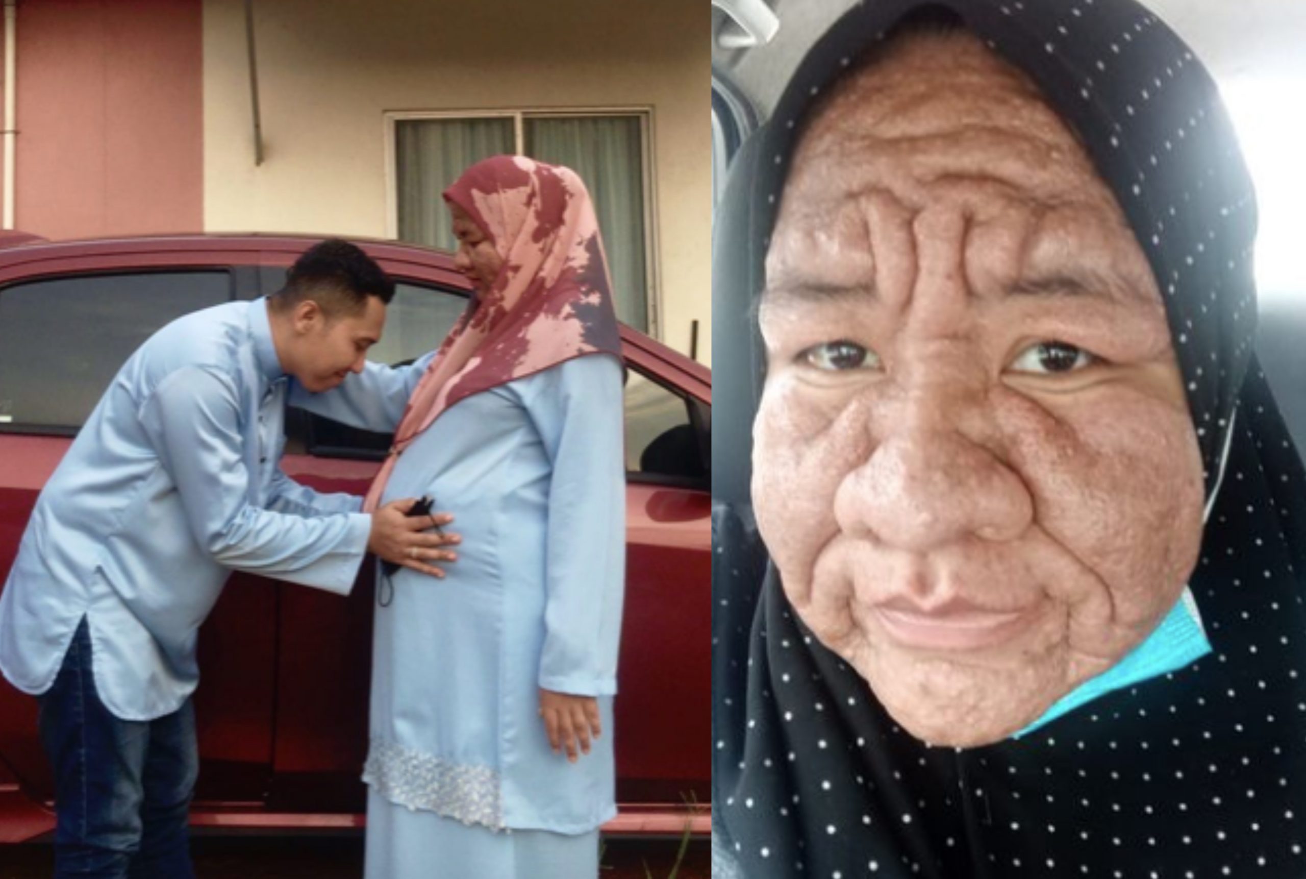Diperli Terkena ‘Sumpahan’, Wanita Kongsi Pengalaman Wajah Bengkak & Berkedut Seperti Orang Tua Ketika Hamil