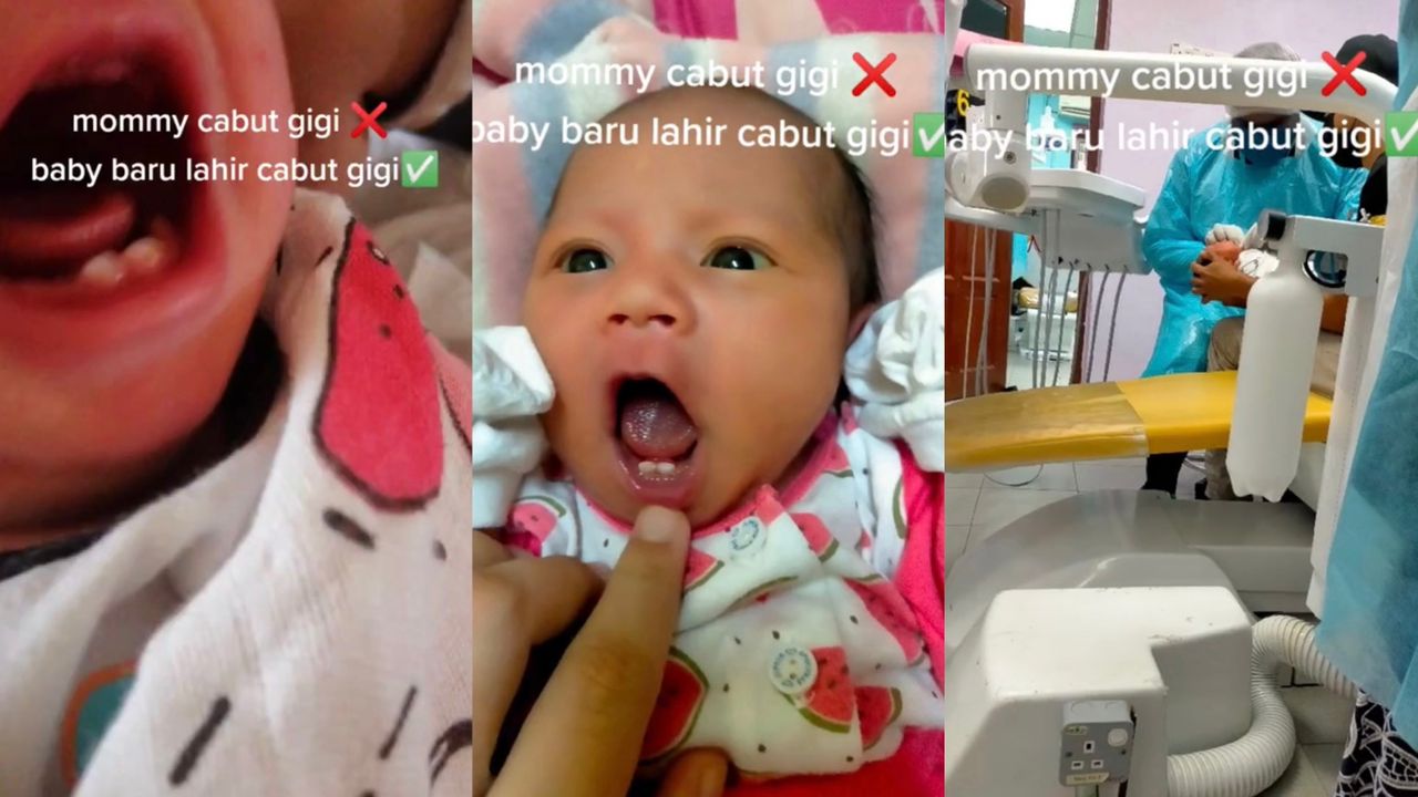 Bayi Baru Lahir Dah Ada Gigi, Ramai Cakap Bawa ‘Tuah’ Tapi Doktor Saran Cabut