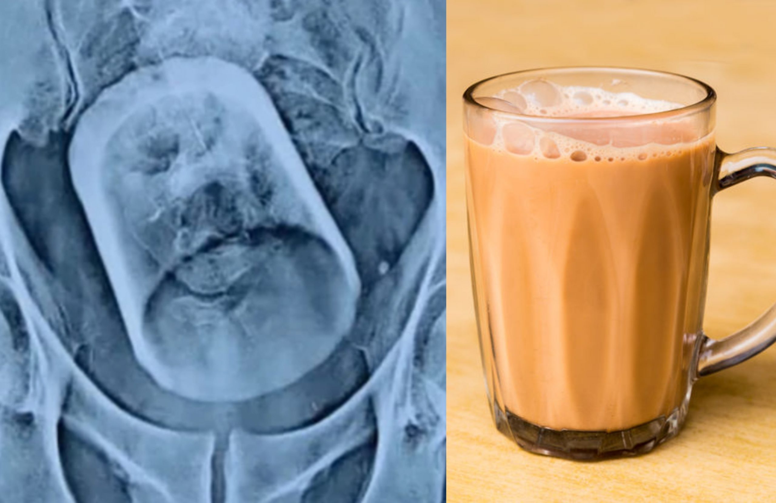 Doktor Terkejut Jumpa Gelas Dalam Perut, Lelaki Mengaku Tertelan Ketika Sedang Menikmati Teh
