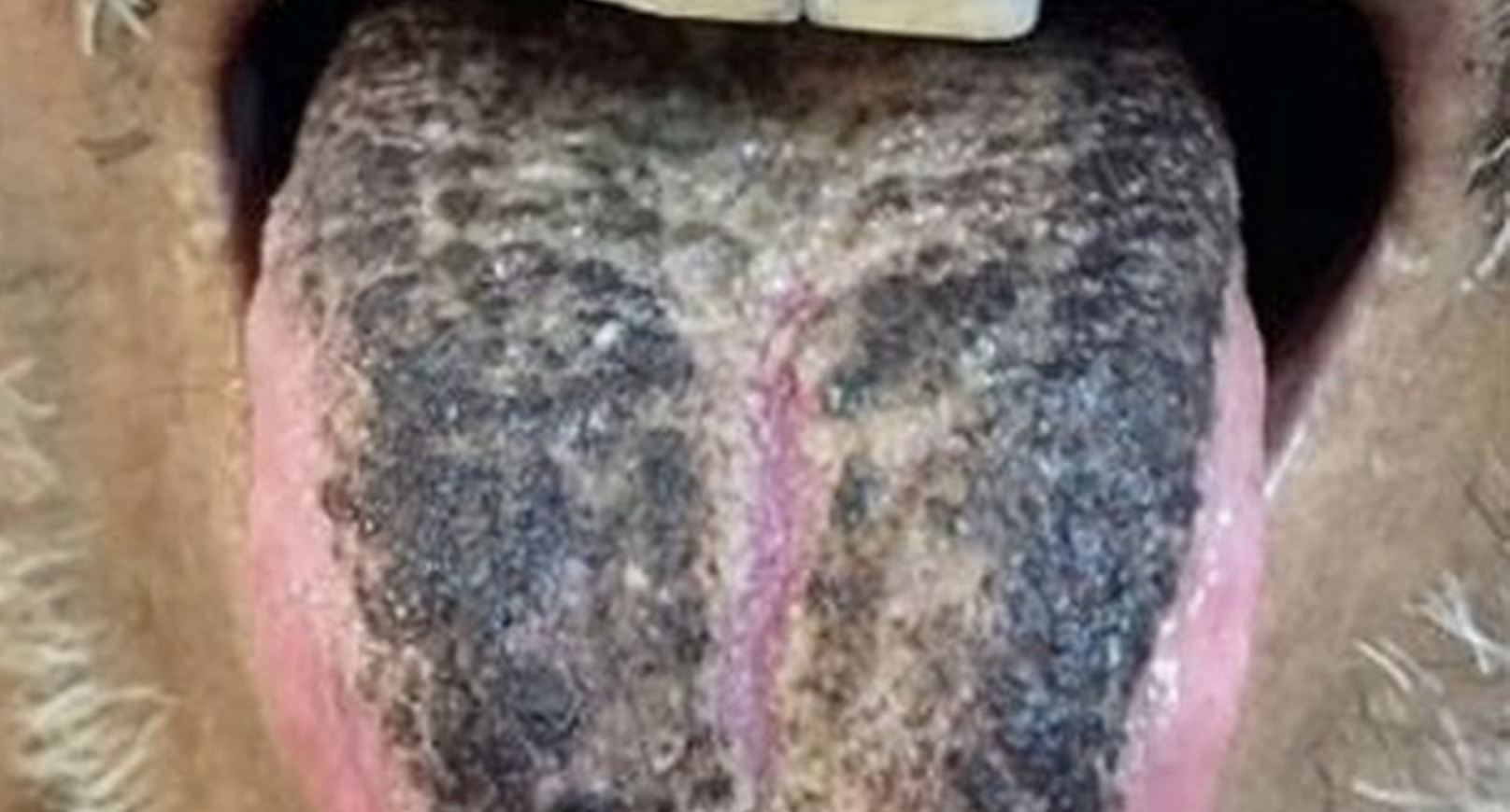 Gara-Gara Diet Cecair, Lidah Lelaki Bertukar Warna Hitam & Ditumbuhi Bulu