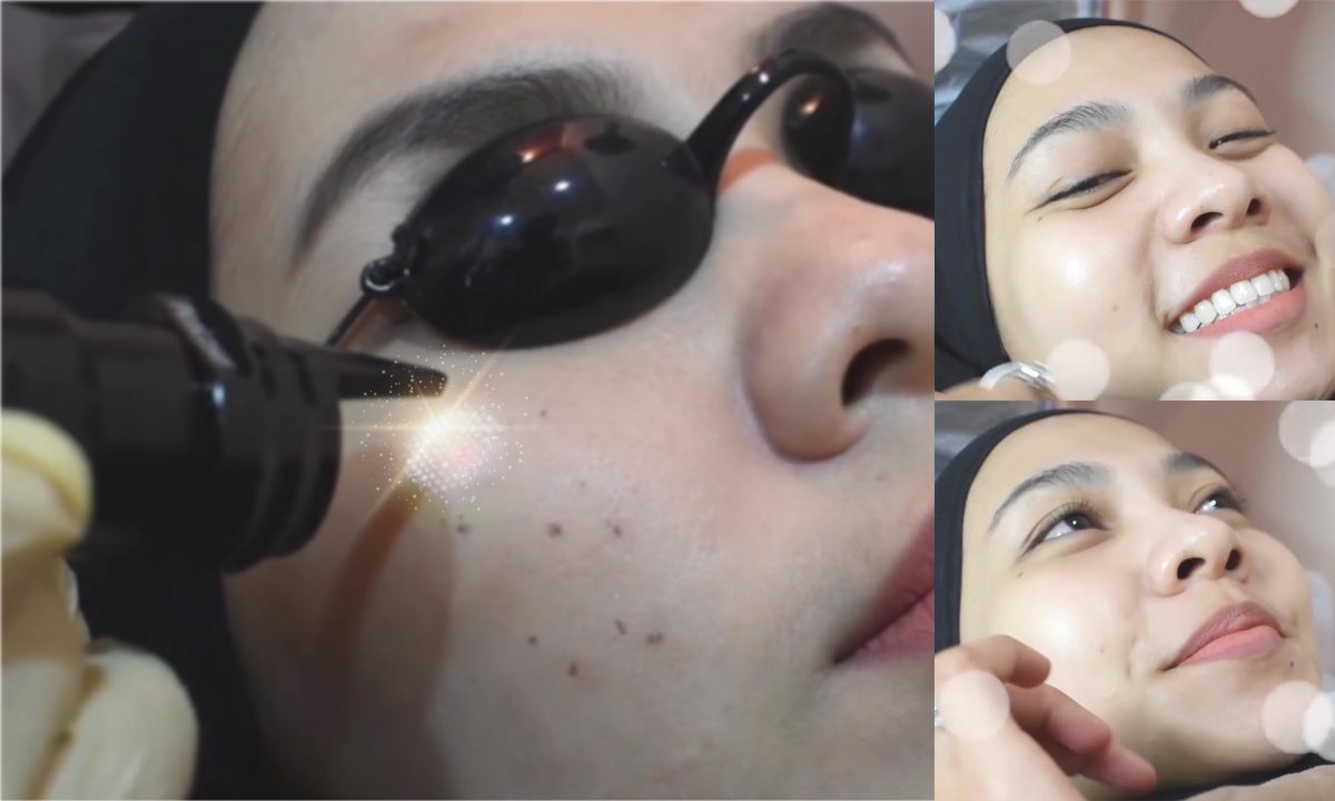1 Sesi PICO SNOW LASER Terus Flawless, Putih Berseri! Confirm Myra tak cari tempat facial lain!