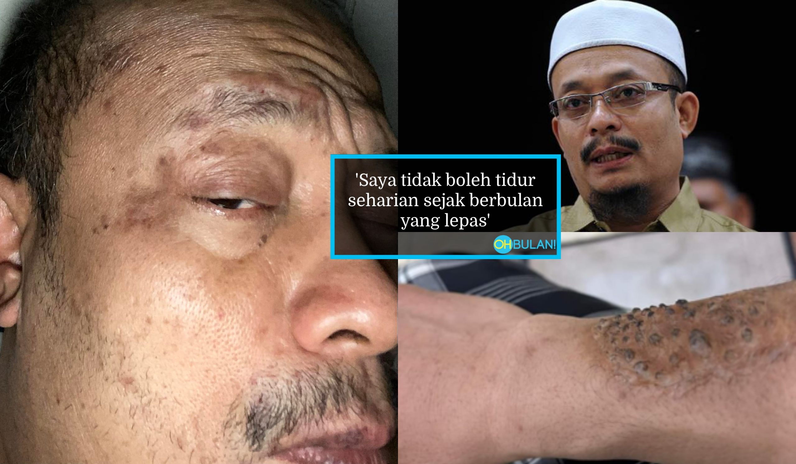 Tak Boleh Sembunyikan Lagi, Ustaz Kazim Dedah Keadaan Wajah Terkini – ‘Satu Badan Pedih, Gatal & Luka Sampai Darah’