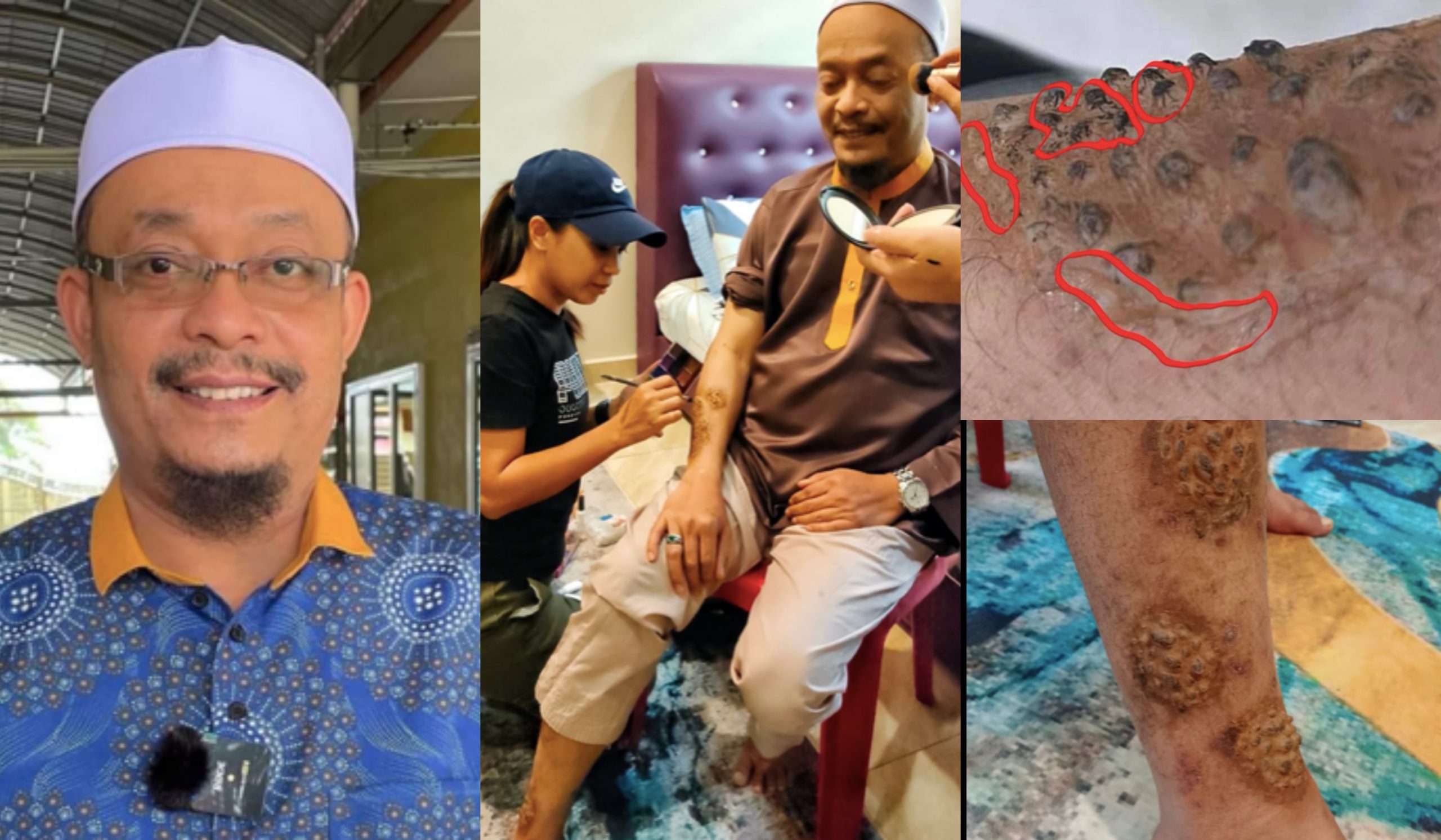 Kecoh Ustaz Kazim Cari Penawar ‘Sakit’ Kulit, Individu Ini Dedah Luka Itu Adalah Solekan Shooting Filem – ‘Itu Luka SFX’