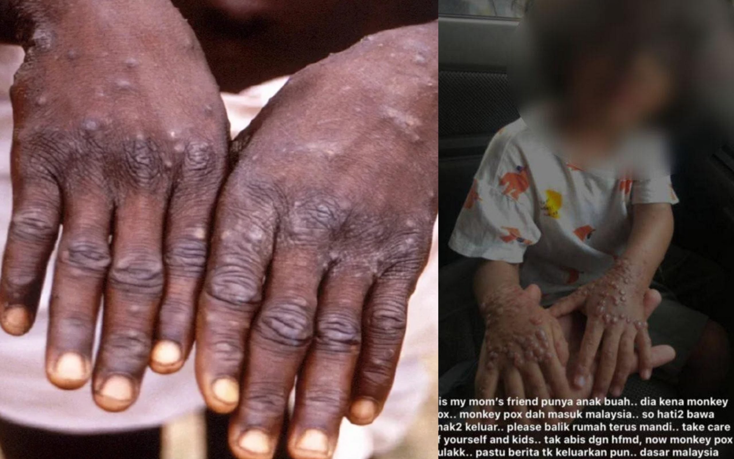 Tiada Kes Cacar Monyet Di Malaysia Seperti Gambar Viral – KKM
