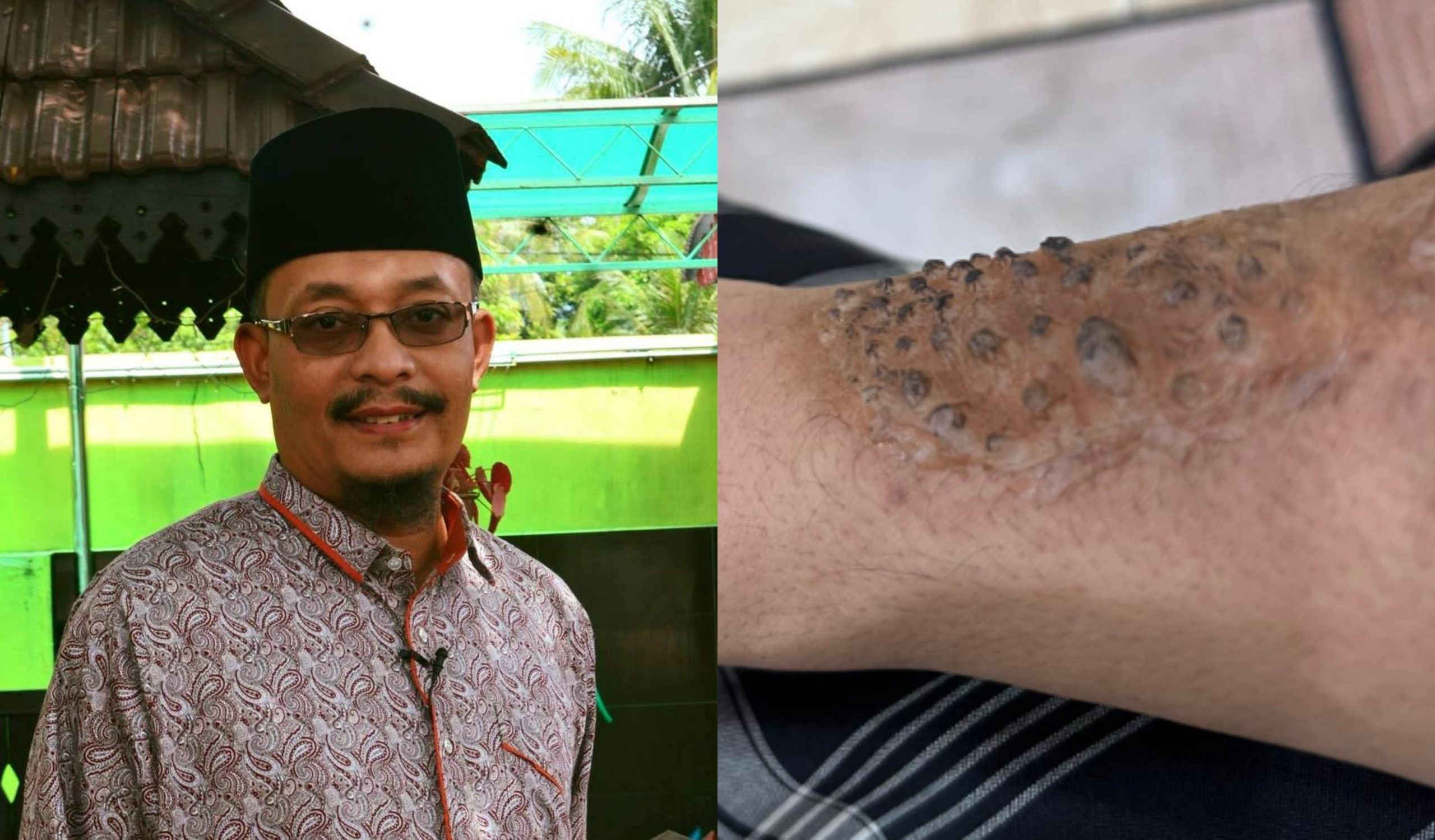 Ustaz Kazim Elias Kongsi Foto Tangan Terbakar & Mohon ‘Bantuan’ Orang Ramai, Netizen Syak Angkara Sihir?