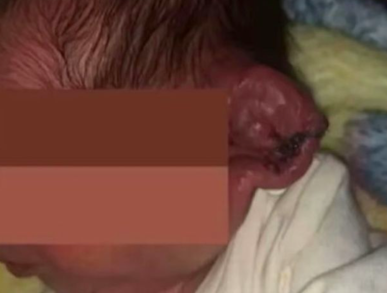 Tiada Bekalan Elektrik Masa Bersalin, Telinga Bayi Hampir Terputus Doktor ‘Operate’ Guna Lampu Telefon Bimbit