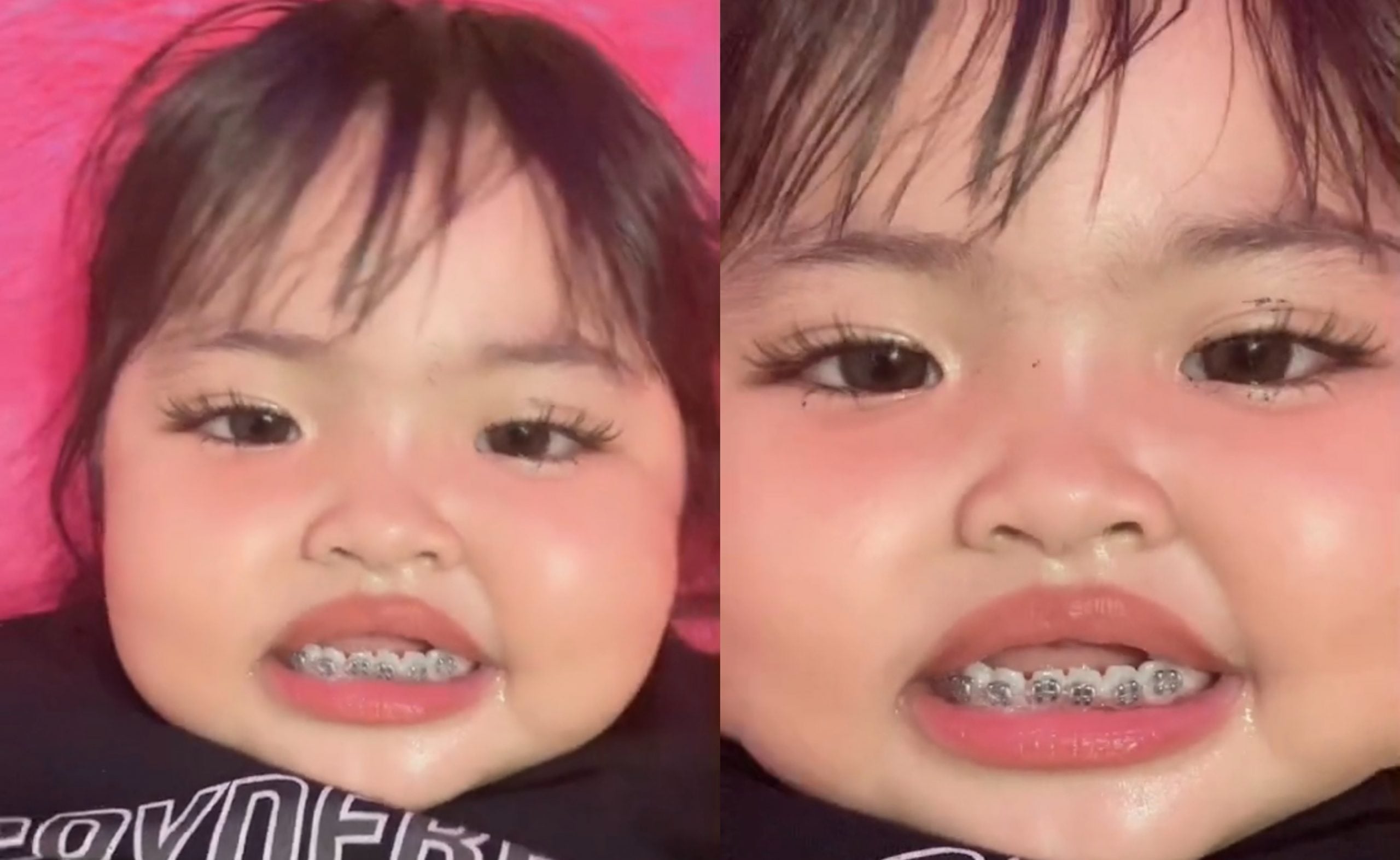 [VIDEO] Netizen Kecam Tindakan Ibu Bapa Pakaikan Anak Kecil Pendakap Gigi – ‘Kasihan Dia, Sakit Tu’