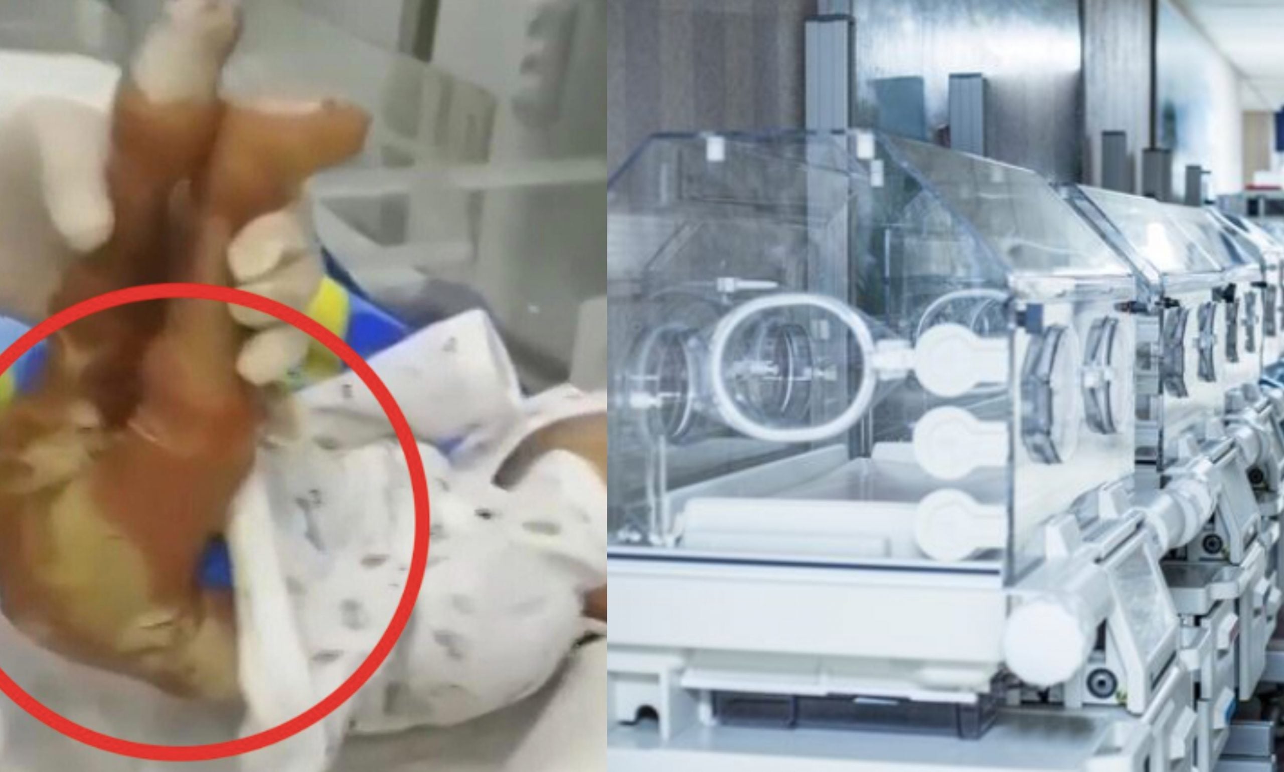 Hasil Sumbang Mahram 2 Beradik, Bayi Hanya Hidup 2 Jam & Alami Pelbagai Komplikasi