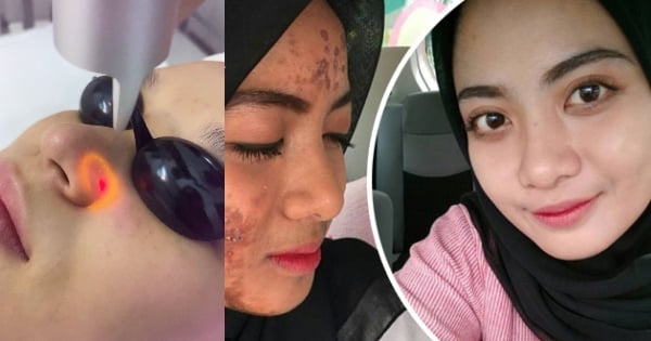 Kami Share Satu Tempat Yang Buat Kulit Berjerawat Jadi Licin Macam Bayi, Hasil Dalam Sekelip Mata Je!