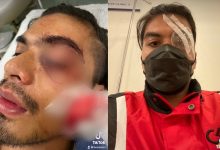[VIDEO] Alami Kecederaan Teruk Di Mata Kiri, Ben Amir Hampir Buta